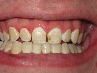 ICON- White Spot Treatment before 300596