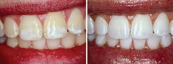 Teeth Whitening with Opalescence before 6653