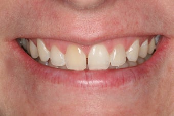 Whitening a single anterior tooth before 343722