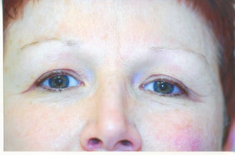 Thermage before 500281