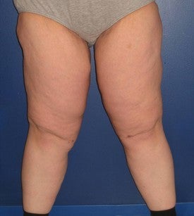 Thigh Lift (Thighplasty) after 97588