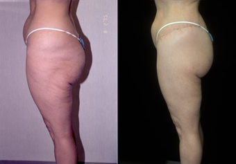 Thigh Lift after 574586