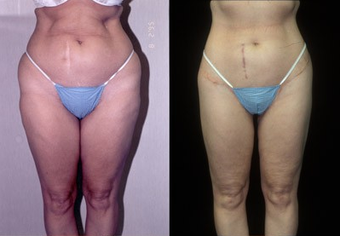 Thigh Lift before 574586