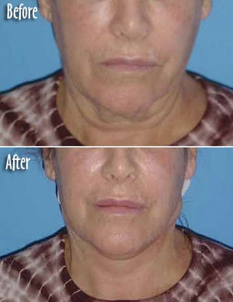 Threadlift of neck
