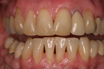 alloderm tissue graft after 330727