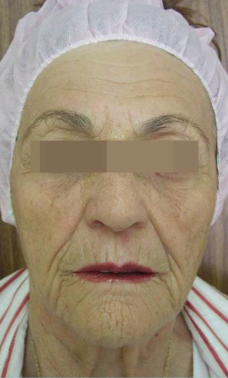 TriPollar after 525434