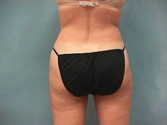 Liposuction after 140075