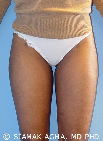 Liposuction after 177445