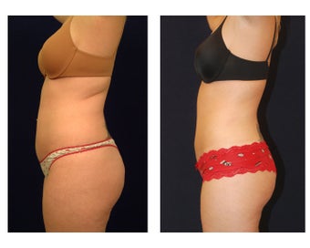 Liposuction before 286757
