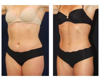 Liposuction before 286776
