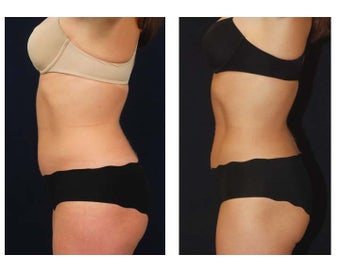 Liposuction before 286779