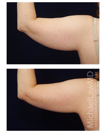 Liposuction after 400286