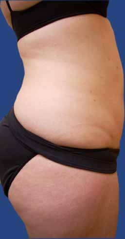 Abdomen Liposuction after 513379