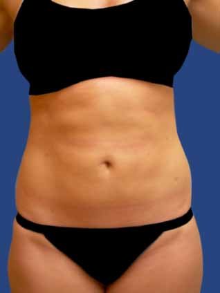 Abdomen Liposuction after 513389