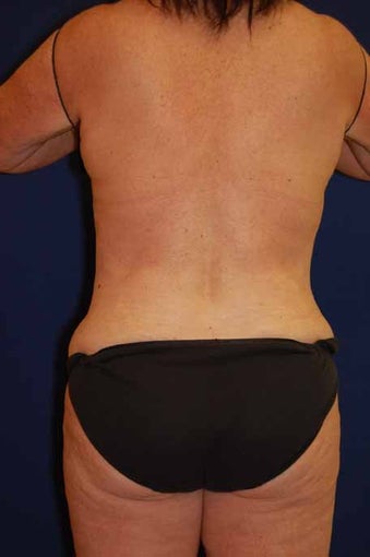 Back / Waist Liposuction after 513396