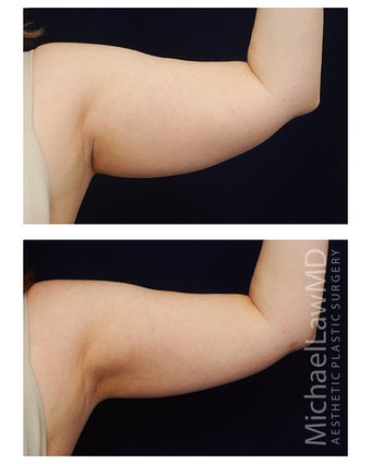 Liposuction before 400286