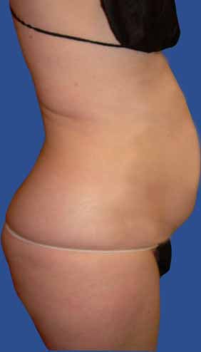 Abdomen Liposuction before 513379