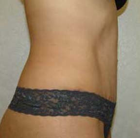 Tummy Tuck after 131641