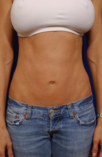 Hybrid abdominoplasty after 279333