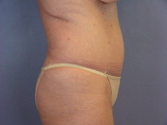 TUMMY TUCK after 280035