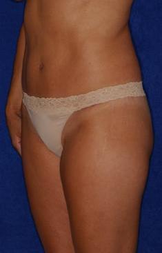 Abdominoplasty after 82406