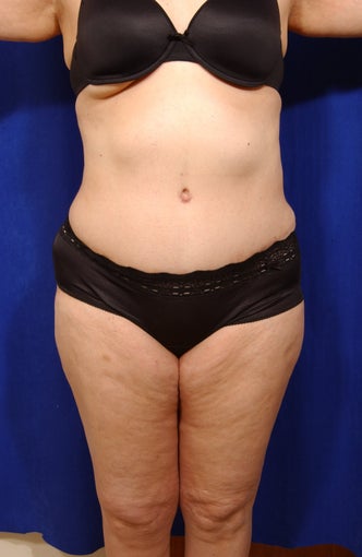 Abdominoplasty with liposculpture of abs, flanks, and waist after 82414