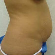 Tummy Tuck before 131641