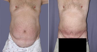 Tummy Tuck of a Male before 262481