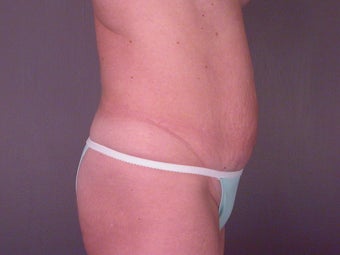 TUMMY TUCK before 280035