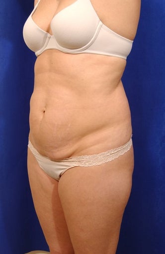 Abdominoplasty before 82406