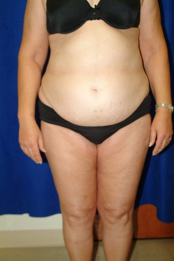 Abdominoplasty with liposculpture of abs, flanks, and waist before 82414