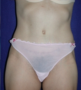 Tummy Tuck after 204408