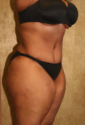 tummy tuck after 304688