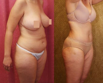 tummy tuck after 304702