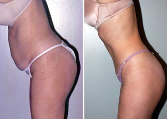 Abdominoplasty (Tummy tuck) after 330698