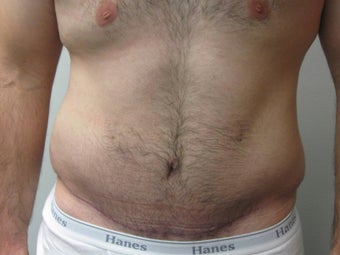 Abdominoplasty on 24 year old man after 335195