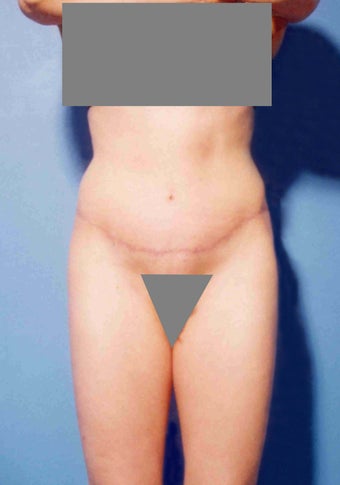 Abdominoplasty after 356389