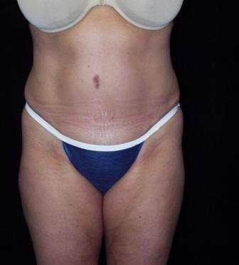 Tummy Tuck with muscle repair after 392082