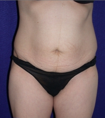 Tummy Tuck before 204408