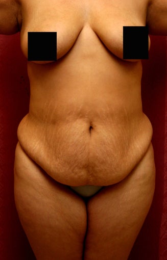 tummy tuck before 304677