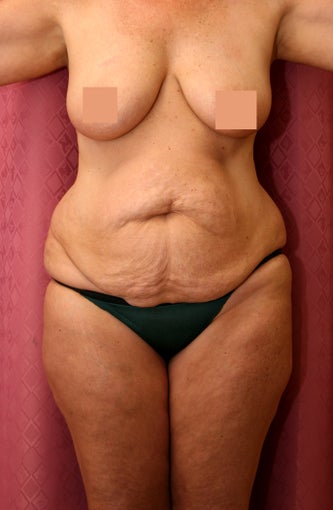 tummy tuck before 304685