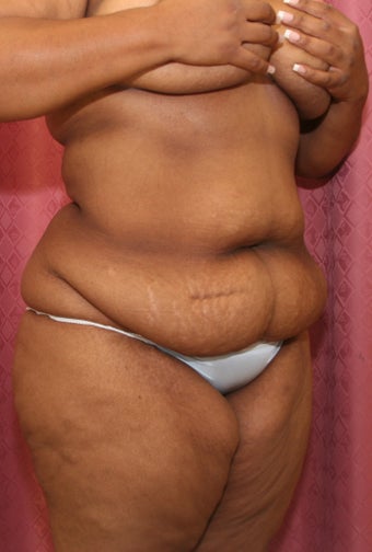 tummy tuck before 304688