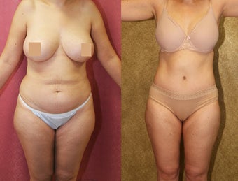 tummy tuck before 304702
