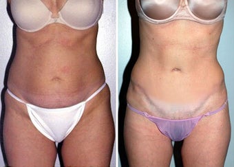 Abdominoplasty (Tummy tuck) before 330698