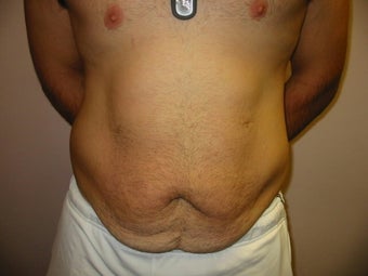 Abdominoplasty on 24 year old man before 335195