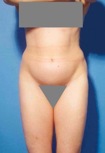 Abdominoplasty before 356389