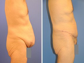Abdominoplasty before 356418