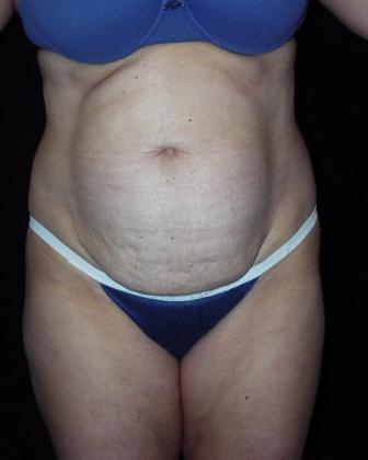 Tummy Tuck with muscle repair before 392082