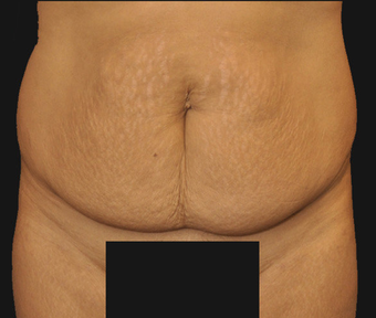 Abdominoplasty before 458932