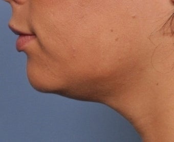 Skin Tightening after 332574